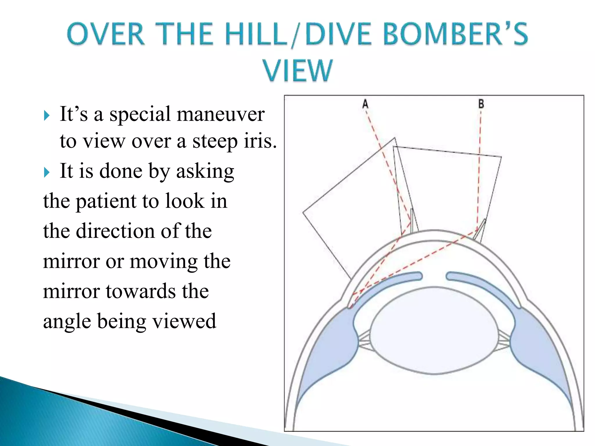  It’s a special maneuver
to view over a steep iris.
 It is done by asking
the patient to look in
the direction of the
mirror or moving the
mirror towards the
angle being viewed
 