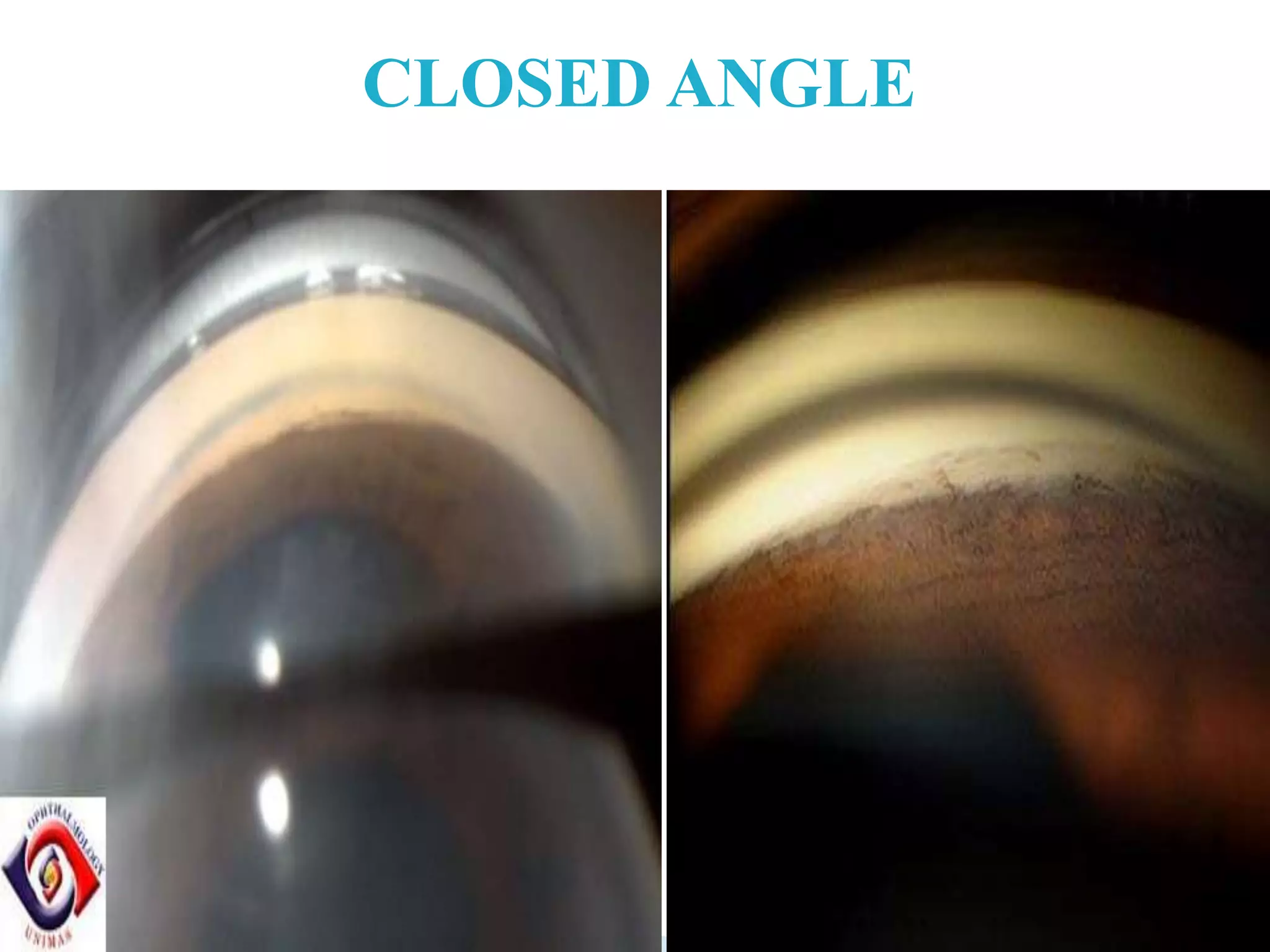 CLOSED ANGLE
 