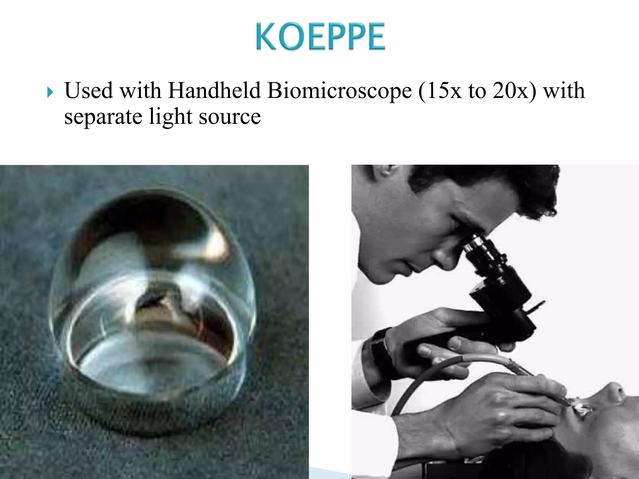  Used with Handheld Biomicroscope (15x to 20x) with
separate light source
 
