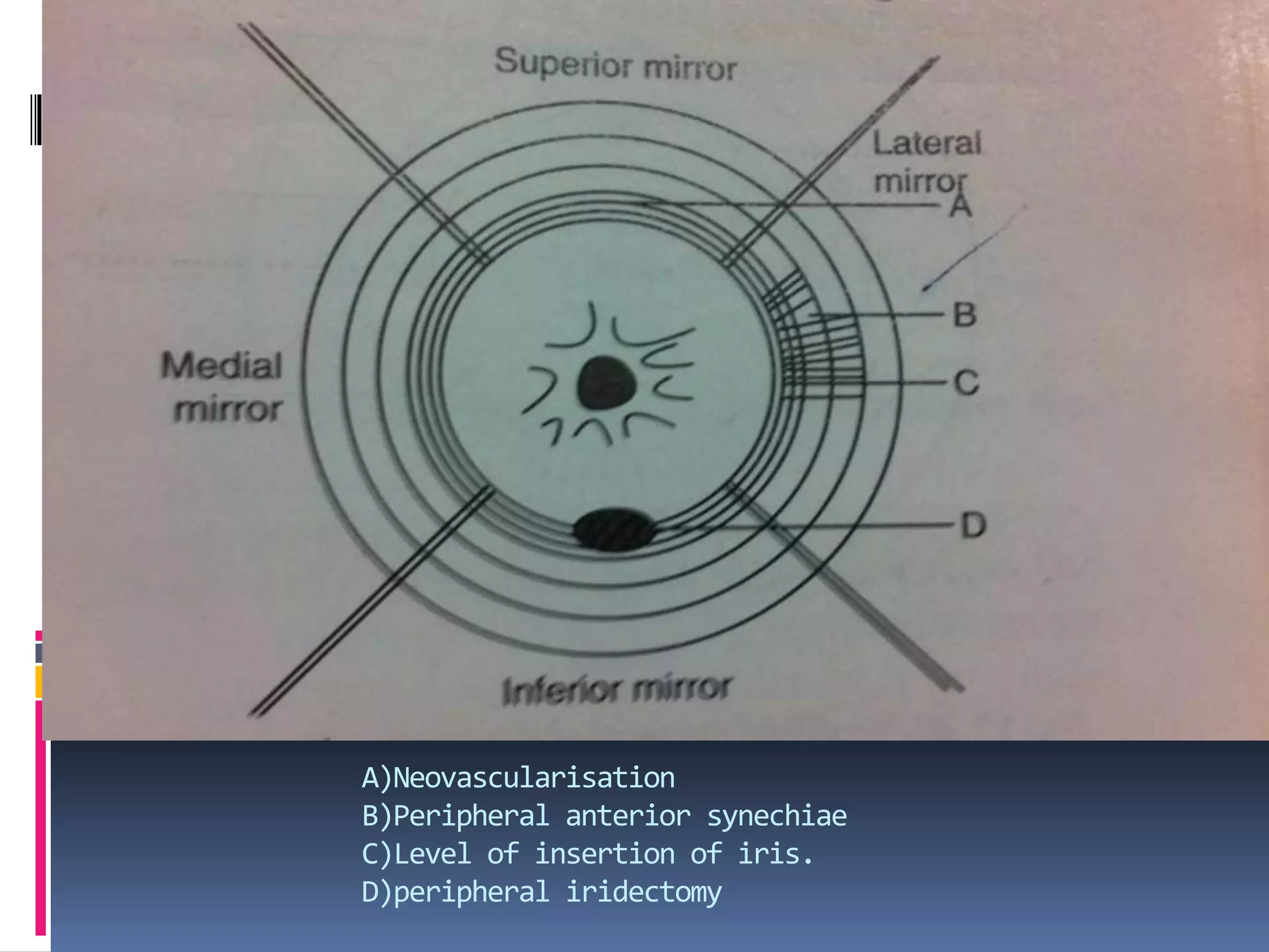 A)Neovascularisation
B)Peripheral anterior synechiae
C)Level of insertion of iris.
D)peripheral iridectomy
 