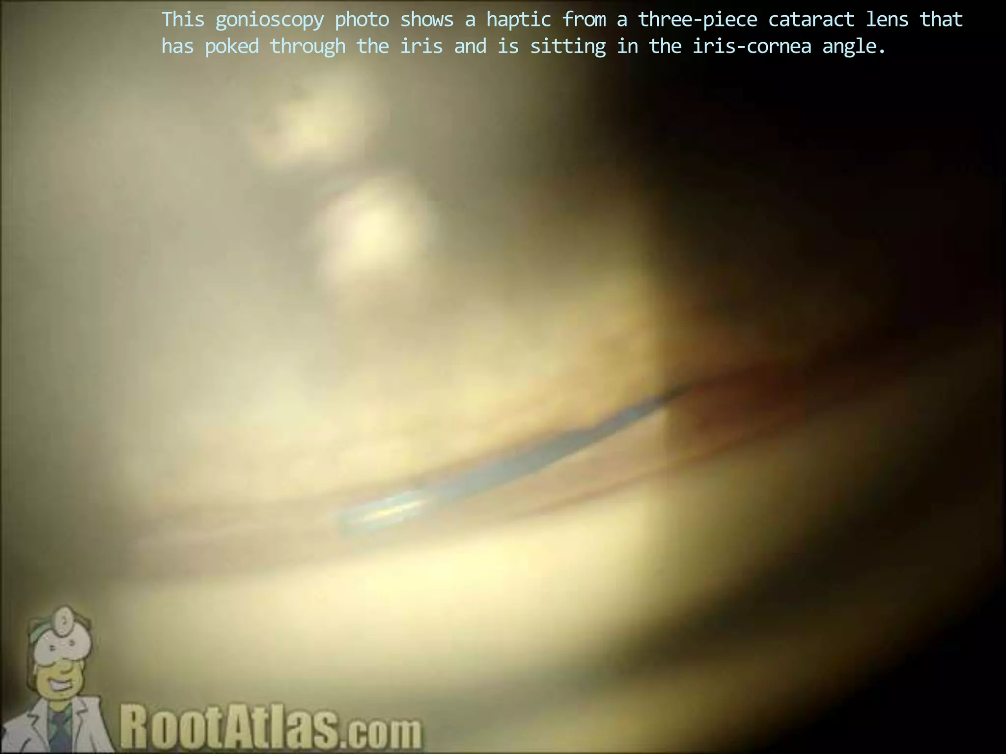 This gonioscopy photo shows a haptic from a three-piece cataract lens that
has poked through the iris and is sitting in the iris-cornea angle.
 