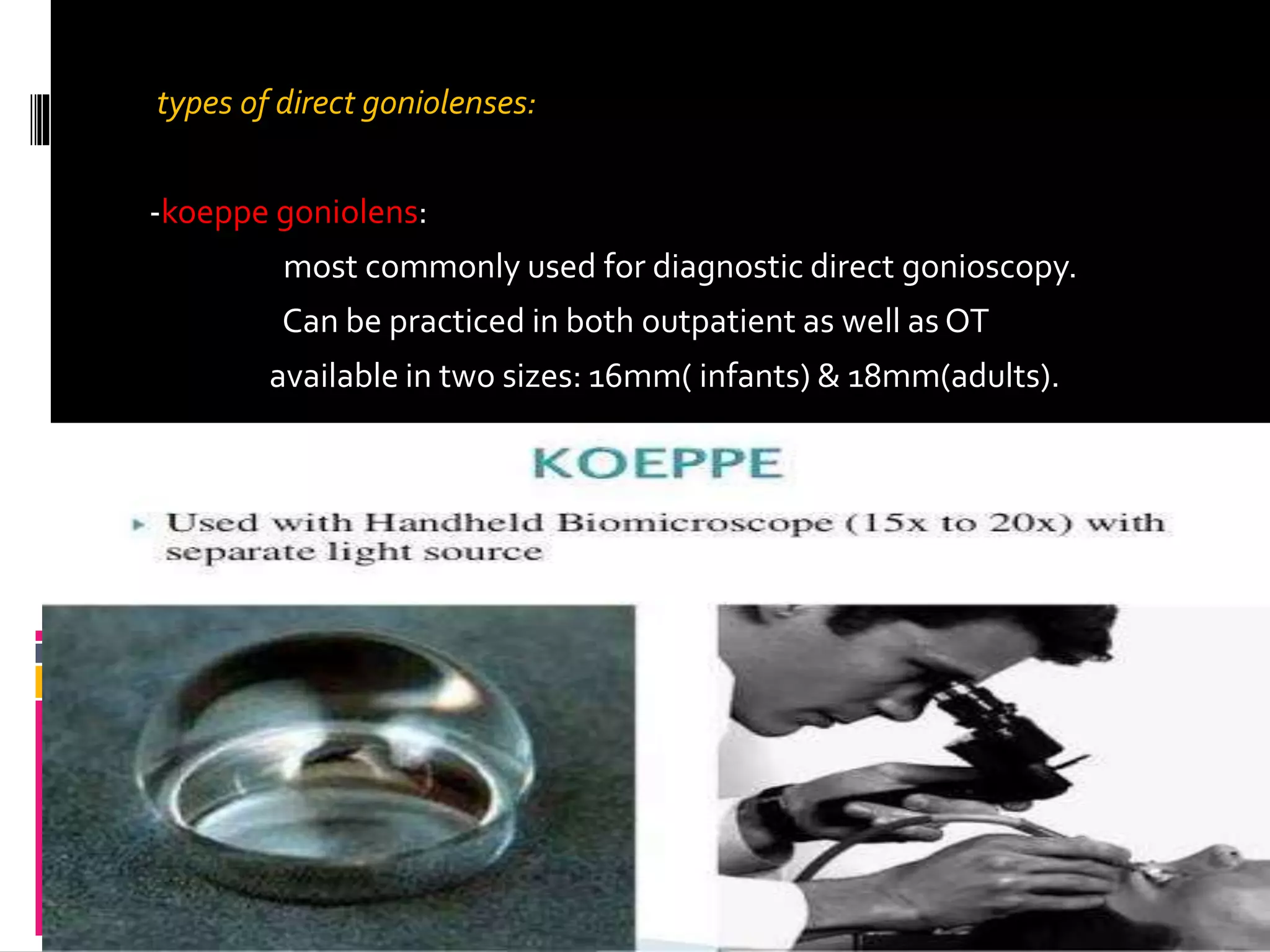 types of direct goniolenses:
-koeppe goniolens:
most commonly used for diagnostic direct gonioscopy.
Can be practiced in both outpatient as well as OT
available in two sizes: 16mm( infants) & 18mm(adults).
 