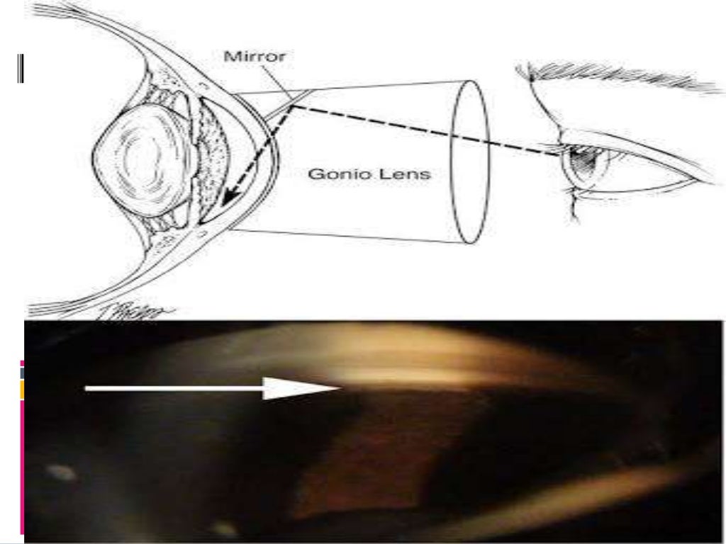 Gonioscopy gonioscopic lenses, principle and clinical aspects
