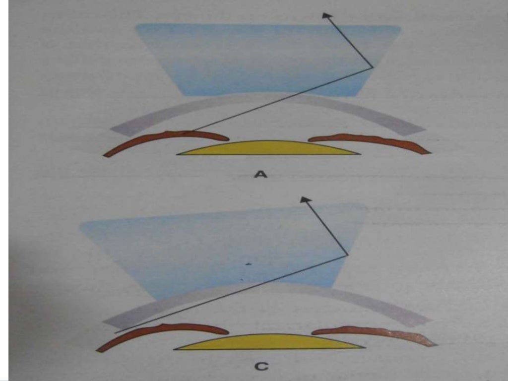 Gonioscopy gonioscopic lenses, principle and clinical aspects