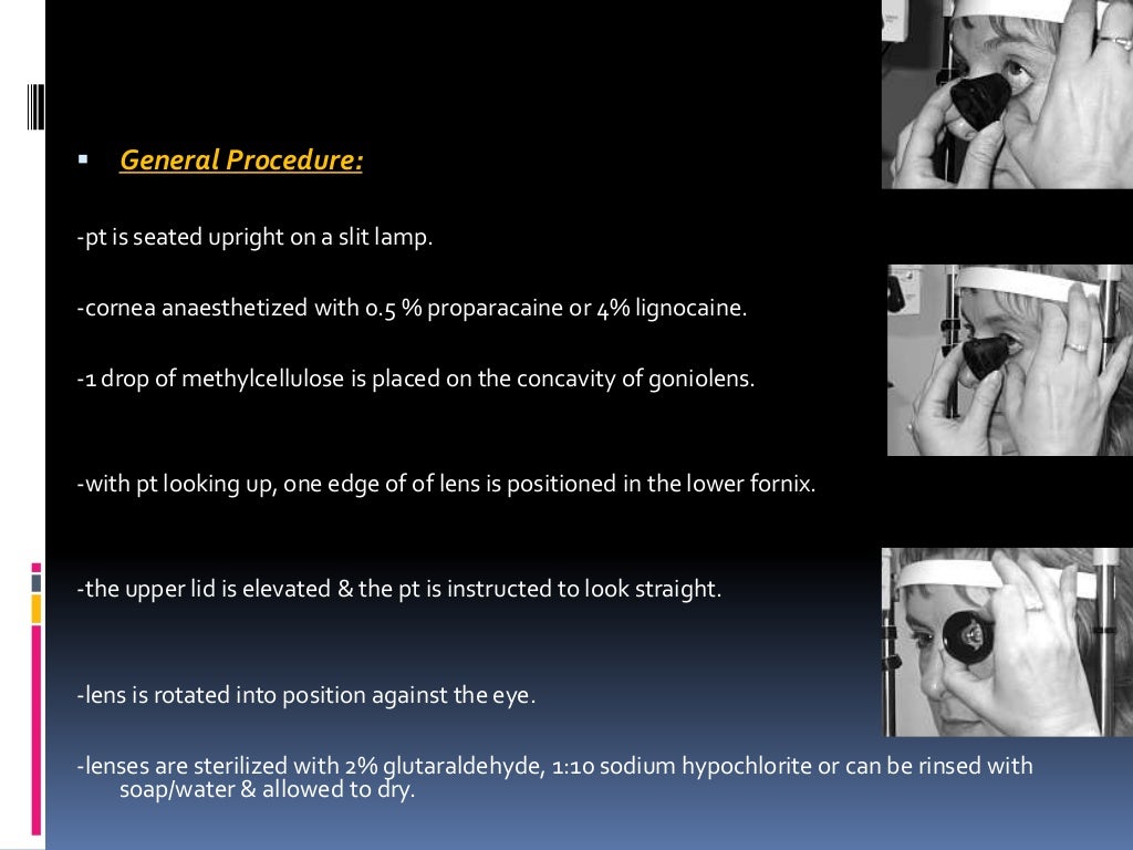 Gonioscopy gonioscopic lenses, principle and clinical aspects