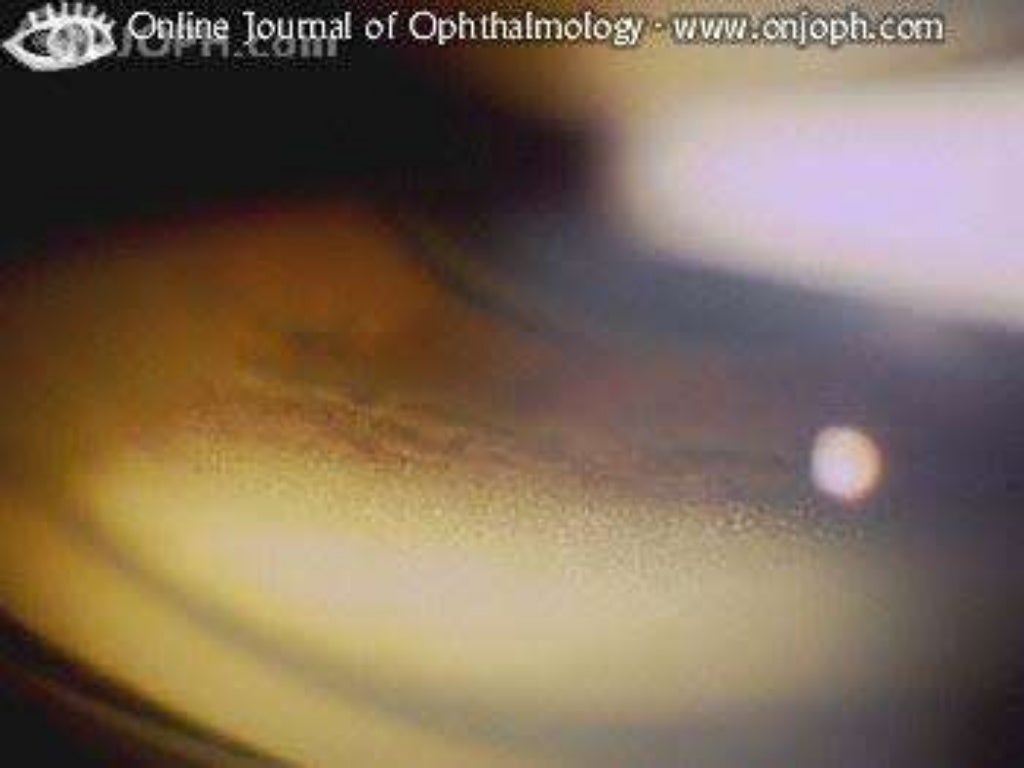 Gonioscopy gonioscopic lenses, principle and clinical aspects