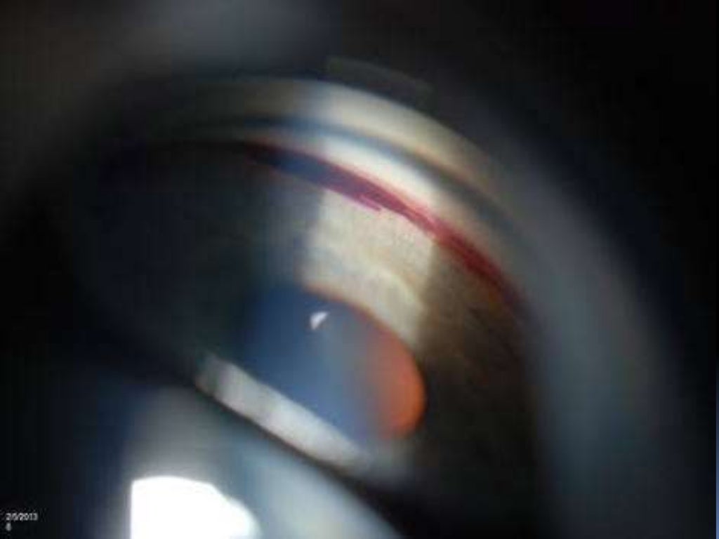 Gonioscopy gonioscopic lenses, principle and clinical aspects