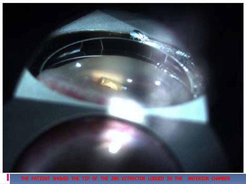 Gonioscopy gonioscopic lenses, principle and clinical aspects