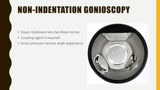 NON-INDENTATION GONIOSCOPY
• Classic Goldmann lens has three mirrors
• Coupling agent is required
• Excess pressure narrows angle appearance
 