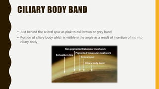 CILIARY BODY BAND
• Just behind the scleral spur as pink to dull brown or grey band
• Portion of ciliary body which is visible in the angle as a result of insertion of iris into
ciliary body
 