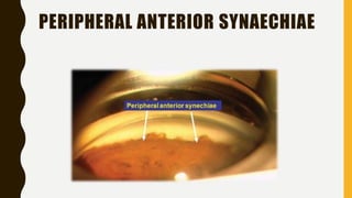 PERIPHERAL ANTERIOR SYNAECHIAE
 
