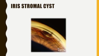 IRIS STROMAL CYST
 