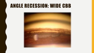 ANGLE RECESSION: WIDE CBB
 