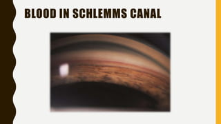 BLOOD IN SCHLEMMS CANAL
 