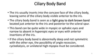 Ciliary Body Band
• The iris usually inserts into the concave face of the ciliary body,
leaving some of the ciliary body visible anterior to the iris.
• The ciliary body band is seen as a light gray to dark brown band
located just anterior to the iris and posterior to the scleral spur.
• This band can be quite wide in myopic or aphakic eyes and
narrow to absent in hyperopic eyes or eyes with anterior
insertions of the iris.
• If the ciliary body band is abnormally deep and not symmetric
with the other eye, the possibility of angle recession,
cyclodialysis, or unilateral high myopia must be considered.
13-03-2020 Kartik Kumar Gupta 16
 