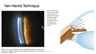 Van–Herick Technique
13-03-2020 Kartik Kumar Gupta 65
 