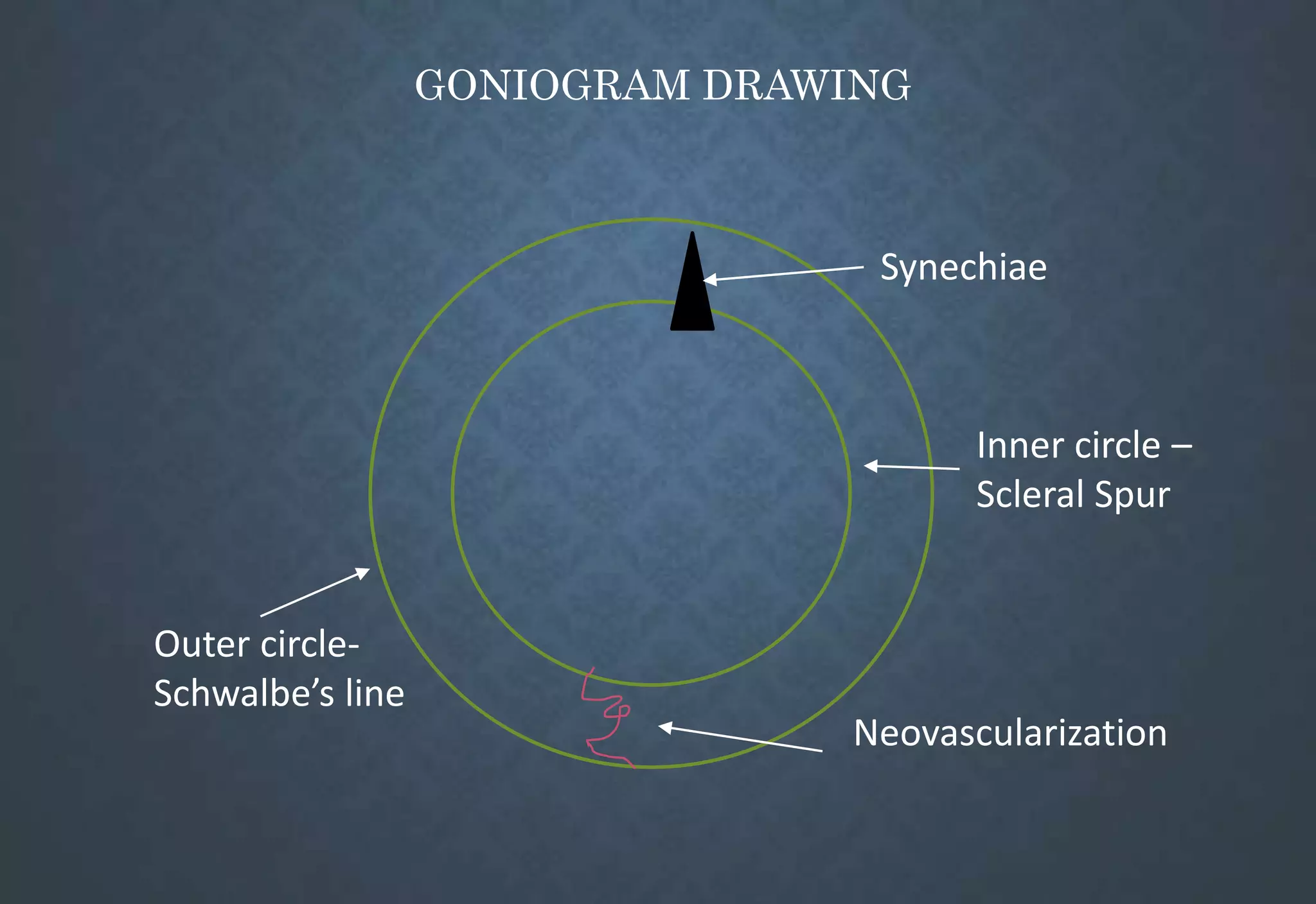 GONIOGRAM DRAWING
Inner circle –
Scleral Spur
Outer circle-
Schwalbe’s line
Synechiae
Neovascularization
 