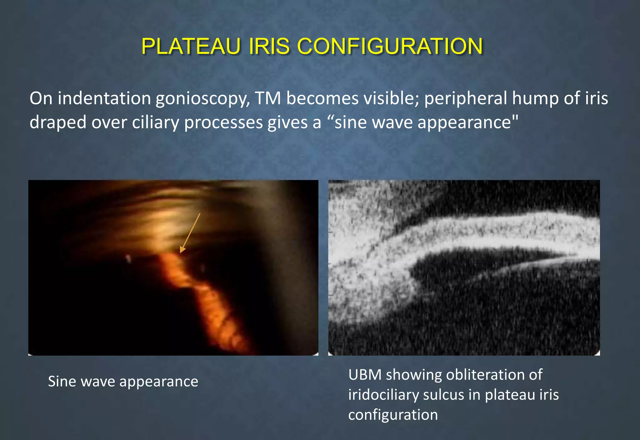 On indentation gonioscopy, TM becomes visible; peripheral hump of iris
draped over ciliary processes gives a “sine wave appearance"
PLATEAU IRIS CONFIGURATION
UBM showing obliteration of
iridociliary sulcus in plateau iris
configuration
Sine wave appearance
 