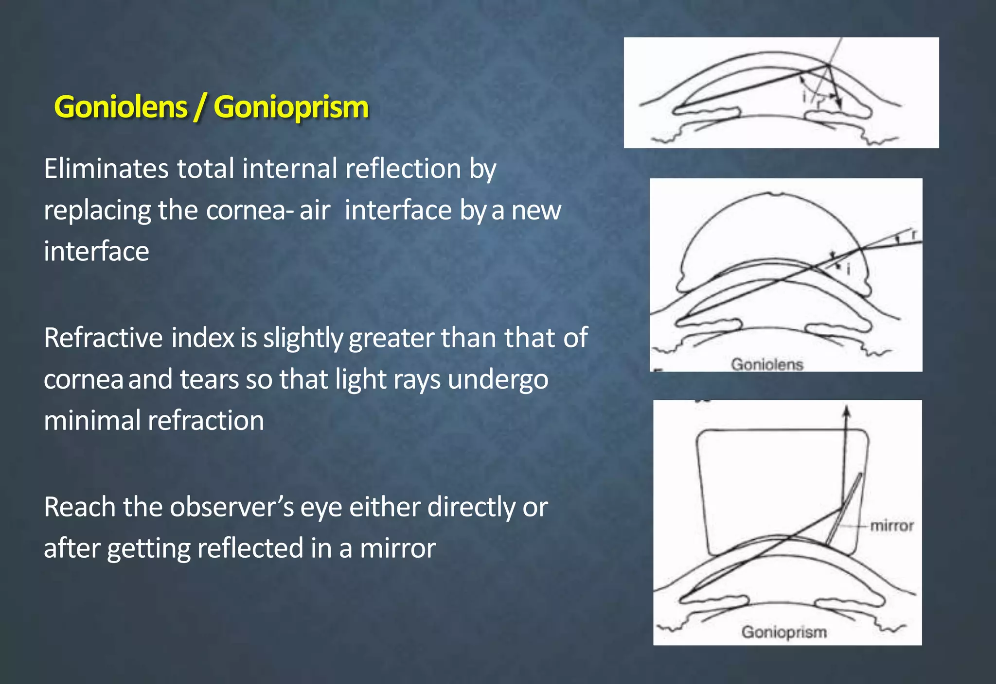 Goniolens/ Gonioprism
Eliminates total internal reflection by
replacing the cornea-air interface bya new
interface
Refractive indexis slightlygreater than that of
corneaand tears so that light rays undergo
minimal refraction
Reach the observer’s eye either directly or
after getting reflected in a mirror
 