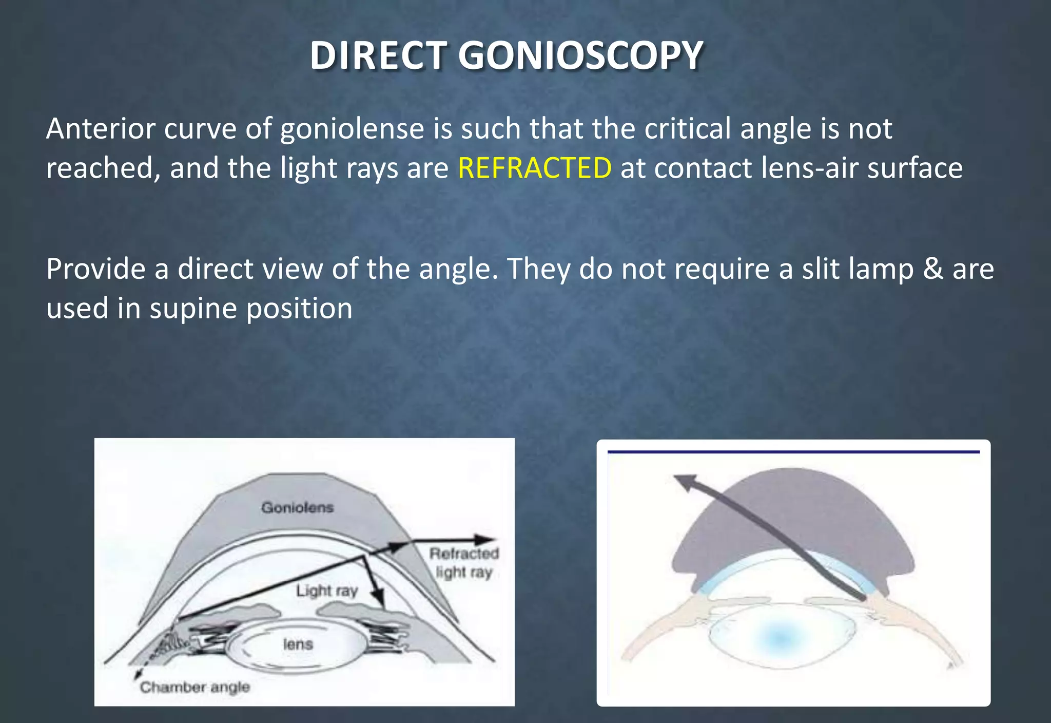 DIRECT GONIOSCOPY
Anterior curve of goniolense is such that the critical angle is not
reached, and the light rays are REFRACTED at contact lens-air surface
Provide a direct view of the angle. They do not require a slit lamp & are
used in supine position
 