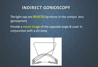 INDIRECT GONIOSCOPY
Thelight rays are REFLECTEDbymirror in the contact lens
(gonioprism)
Providea mirror image of the opposite angle & used in
conjunction with a slit lamp
 