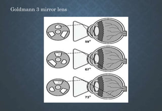 Goldmann 3 mirror lens
 