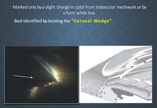 Marked only bya slight changein colorfrom trabecular meshwork or by
a faint white line.
Best identified bylocating the “Corneal Wedge”.
 