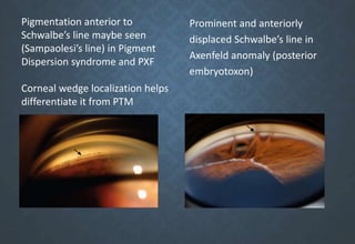 Prominent and anteriorly
displaced Schwalbe’s line in
Axenfeld anomaly (posterior
embryotoxon)
Pigmentation anterior to
Schwalbe’s line maybe seen
(Sampaolesi’s line) in Pigment
Dispersion syndrome and PXF
Corneal wedge localization helps
differentiate it from PTM
 