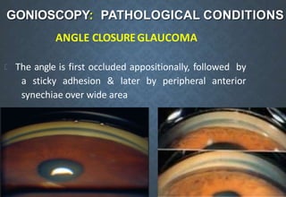 GONIOSCOPY: PATHOLOGICAL CONDITIONS
ANGLE CLOSUREGLAUCOMA
The angle is first occluded appositionally, followed by
a sticky adhesion & later by peripheral anterior
synechiae over wide area
.
 