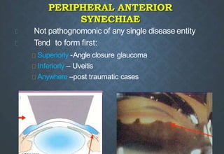 PERIPHERAL ANTERIOR
SYNECHIAE
Not pathognomonic of any single disease entity
Tend to form first:
Superiorly -Angle closure glaucoma
Inferiorly – Uveitis
Anywhere –post traumatic cases
 