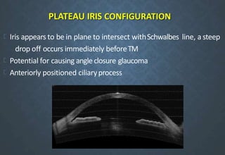 PLATEAU IRIS CONFIGURATION
Iris appears to be in plane to intersect withSchwalbes line, a steep
drop off occurs immediately beforeTM
Potential for causing angle closure glaucoma
Anteriorly positioned ciliaryprocess
 