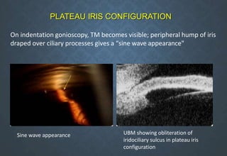 On indentation gonioscopy, TM becomes visible; peripheral hump of iris
draped over ciliary processes gives a “sine wave appearance"
PLATEAU IRIS CONFIGURATION
UBM showing obliteration of
iridociliary sulcus in plateau iris
configuration
Sine wave appearance
 