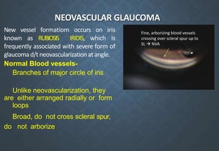 NEOVASCULAR GLAUCOMA
New vessel formatiom occurs on iris
known as RUBIOSIS IRIDIS, which is
frequently associated with severe form of
glaucomad/t neovascularizationatangle.
Normal Blood vessels-
Branches of major circle of iris
Unlike neovascularization, they
are either arranged radially or form
loops
Broad, do not cross scleral spur,
do not arborize
Fine, arborizing blood vessels
crossing over scleral spur up to
SL  NVA
 