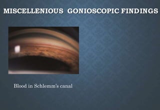 MISCELLENIOUS GONIOSCOPIC FINDINGS
Blood in Schlemm’s canal
 