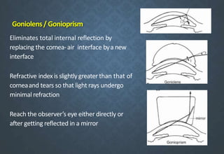 Goniolens/ Gonioprism
Eliminates total internal reflection by
replacing the cornea-air interface bya new
interface
Refractive indexis slightlygreater than that of
corneaand tears so that light rays undergo
minimal refraction
Reach the observer’s eye either directly or
after getting reflected in a mirror
 