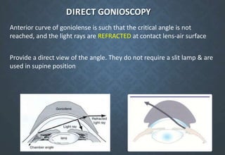 DIRECT GONIOSCOPY
Anterior curve of goniolense is such that the critical angle is not
reached, and the light rays are REFRACTED at contact lens-air surface
Provide a direct view of the angle. They do not require a slit lamp & are
used in supine position
 