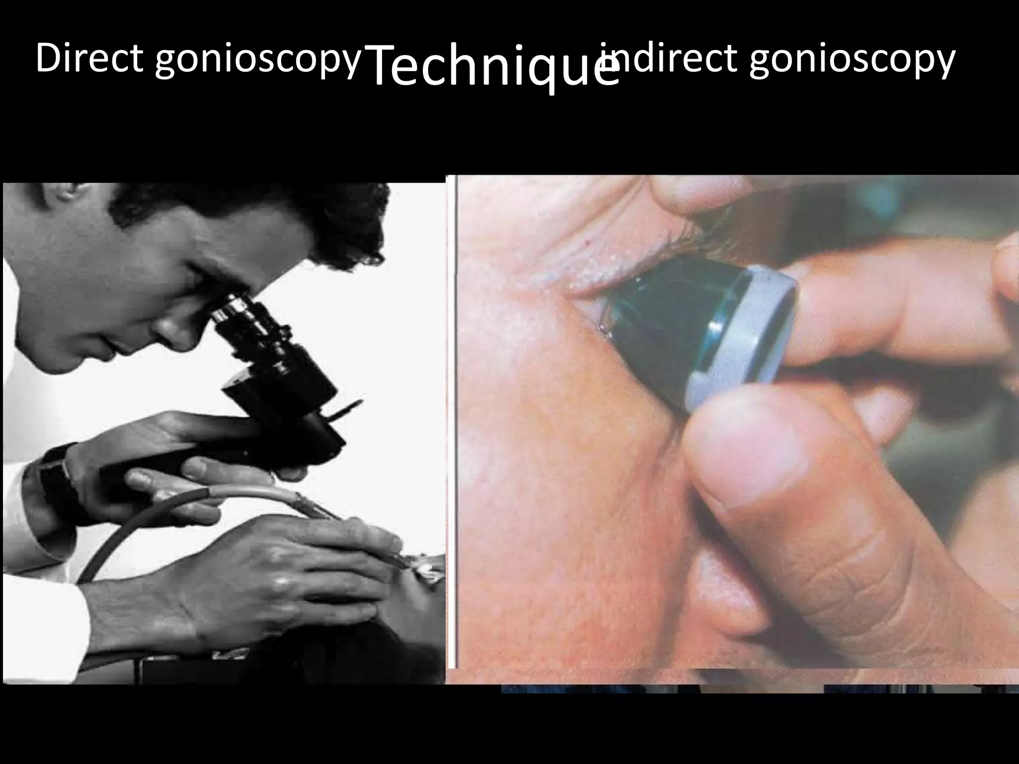 Direct gonioscopy Technique
                          indirect gonioscopy
 