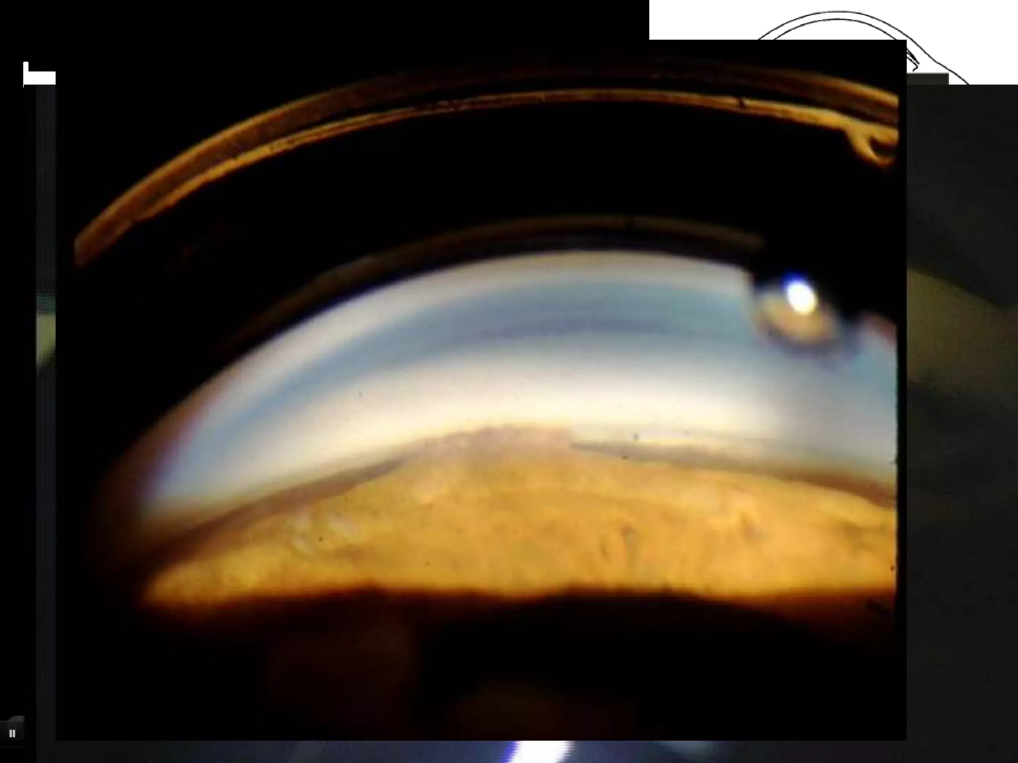 Indentation gonioscopy
 • By changing amount of
   pressure on cornea one
   can observe effect on
   angle width.
 • Appositional vs PAS .
 • Platue iris syndrom
 • Phacomorphic glaucoma
 