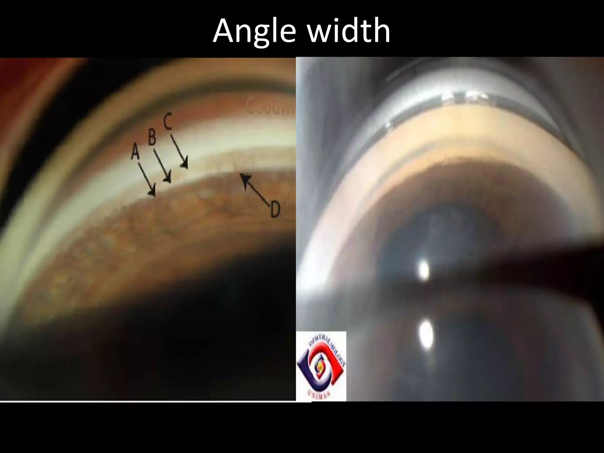 Angle width
• Estimated by examining the distance between
  schwalbe’s line and nearest part of iris .
• If angle between iris and TM is 20 to 45 deg :wide ,
                                      <20 deg       :narrow
• Angle :wide/open/narrow/closed :
  irregular narrowing : subacute angle closure glaucoma
                           dislocation of lens,cycts,
                         posterior adhesions plus pupillary block
  Irregular widening :traumatic recession ,
                      dislocation of lens,cyclodialysis
 