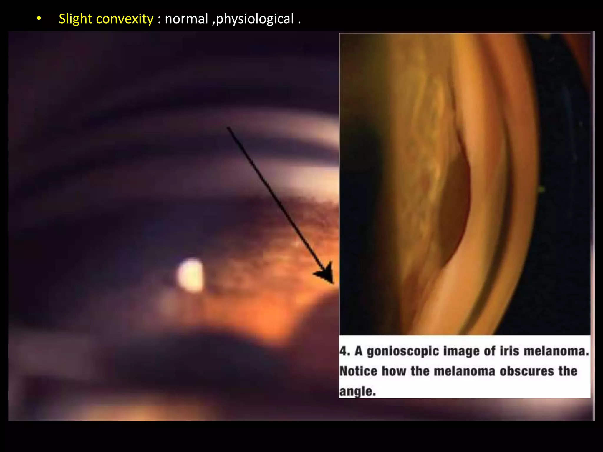 •   Slight convexity : normal ,physiological .
•   Excessive convexity:hyperopia , ACG .

•   Platue iris: ACG .

•   Flat iris : pigmentary glaucoma,
                myopia ,aphakia .

•   Concave iris :PDS, cyclitic membrane ,
                 PAS in aphakia .

•   Irregularity of contour : dislocation of lens
                             cyst or tumor
•   Segmental atrophy of iris : previous acute glaucoma ,
                                herpes zoster

•   Pigment spickling : EXF , pigmentary glaucoma,
                       malignant glaucoma,tum&cysts.

•   Pigment abnormalities: nevus ,heterocromatic cyclitis
                          glaucoma cyclitic crises
                          hemangioma ,neurofibroma ,siderosis.
 