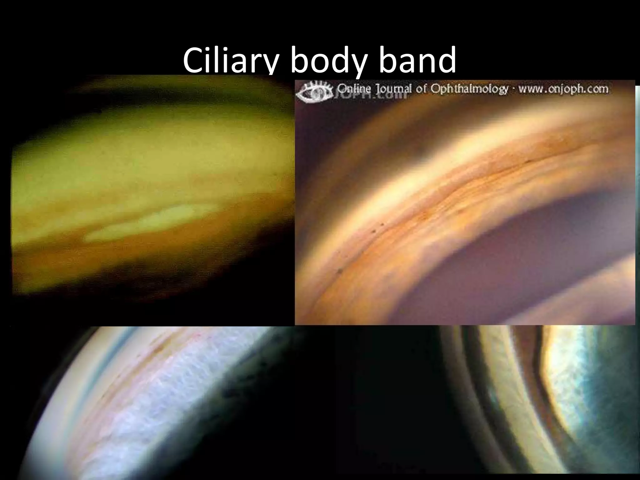 Ciliary body band
    Very light gray --------------------   N in white race
C
O
    Darker gray,traces of brown --         N in dark races
L   Darker, slate gray ----------------    melanoma.
O   Whitish, cobwebby -------------        tear into muscle
U
R
    Scleral white
    cleft behind the S spur----------      cyclodailysis



W   Narrower --------------hyperopics , PAS ,
I
D
    Unusually narrow--- congenital glaucoma
T   Wider -------------------myopics, tear into CB
H                            cyclodialysis
 