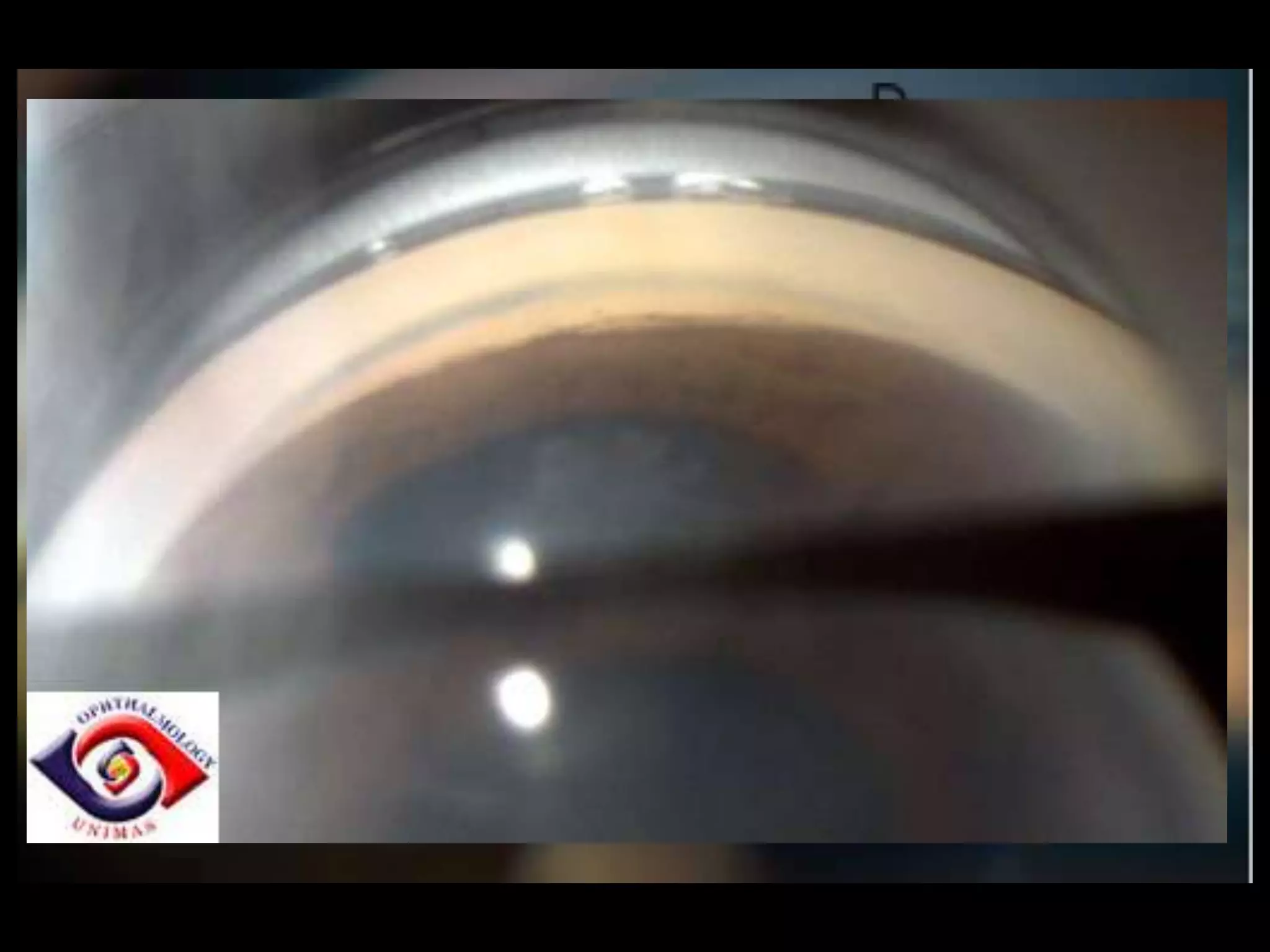 Scleral spur
• Grey white line of varying width,this white colour makes it
  most helpful landmark for rapid orientation .

   Spur all visible ------------------------open angle
   Spur hidden---------------------------uveal meshwork
                                             excessively narrow angle
                                            closed angle
                                            synechias
   Unusually prominent and white--torn uvealmeshwork,
                                            ciliary muscle torn,
                                            cyclodialysis
 