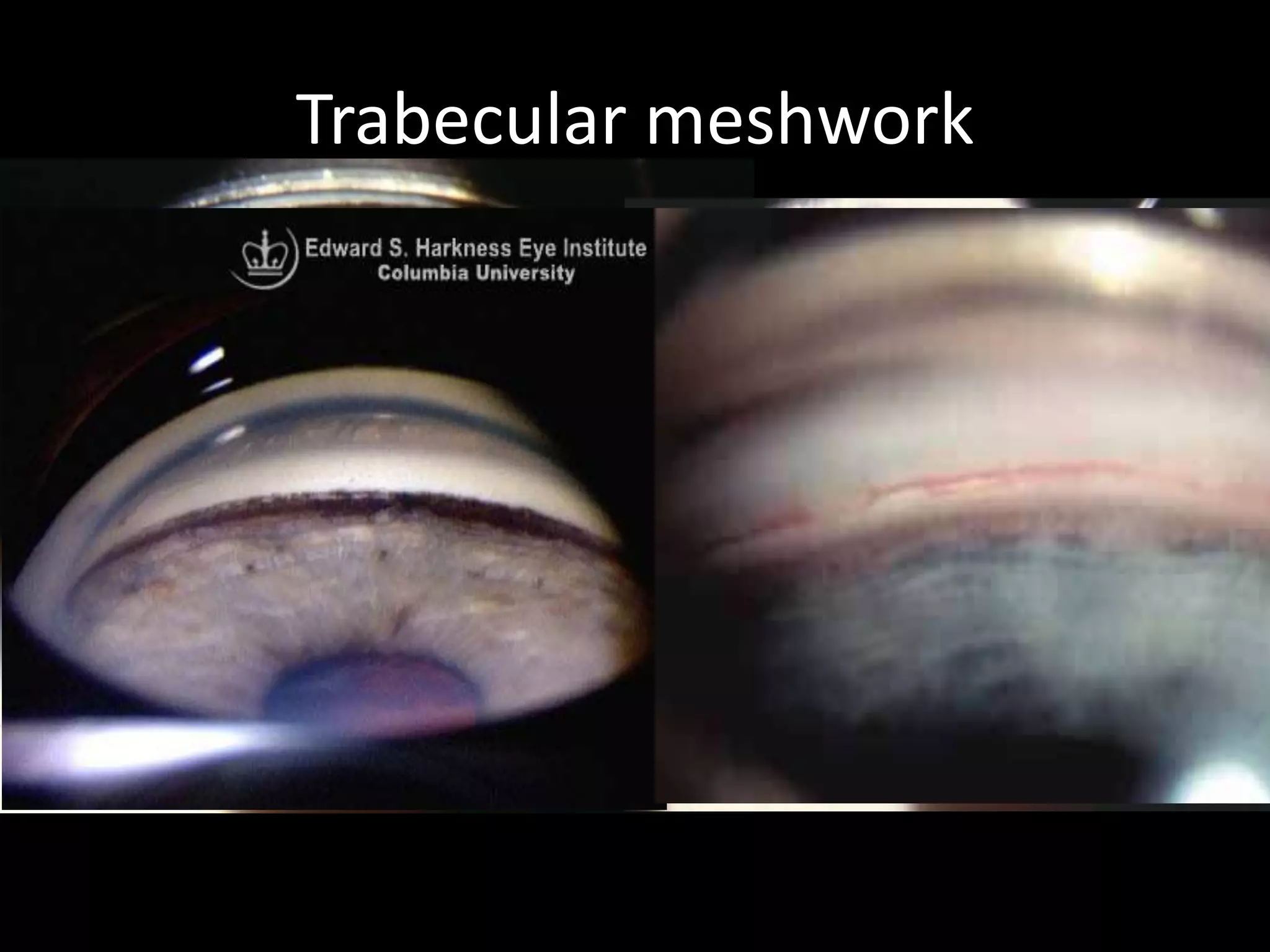 Trabecular meshwork
• Normal variable :covered by uveal meshwork
                      blood in schlemn canal
• Charecteristic : filteration area finely granular
  translucent with or without pigment.
• Abnormalities: execessive pigmentation
                       inflammatory exudates
                       blood vessels
                       synechias
                       loss of normal textures
                       traumatic rupture
Congenital abnormalities : posterior embryotoxon (reiger)
                           iridocorneal malformations
 