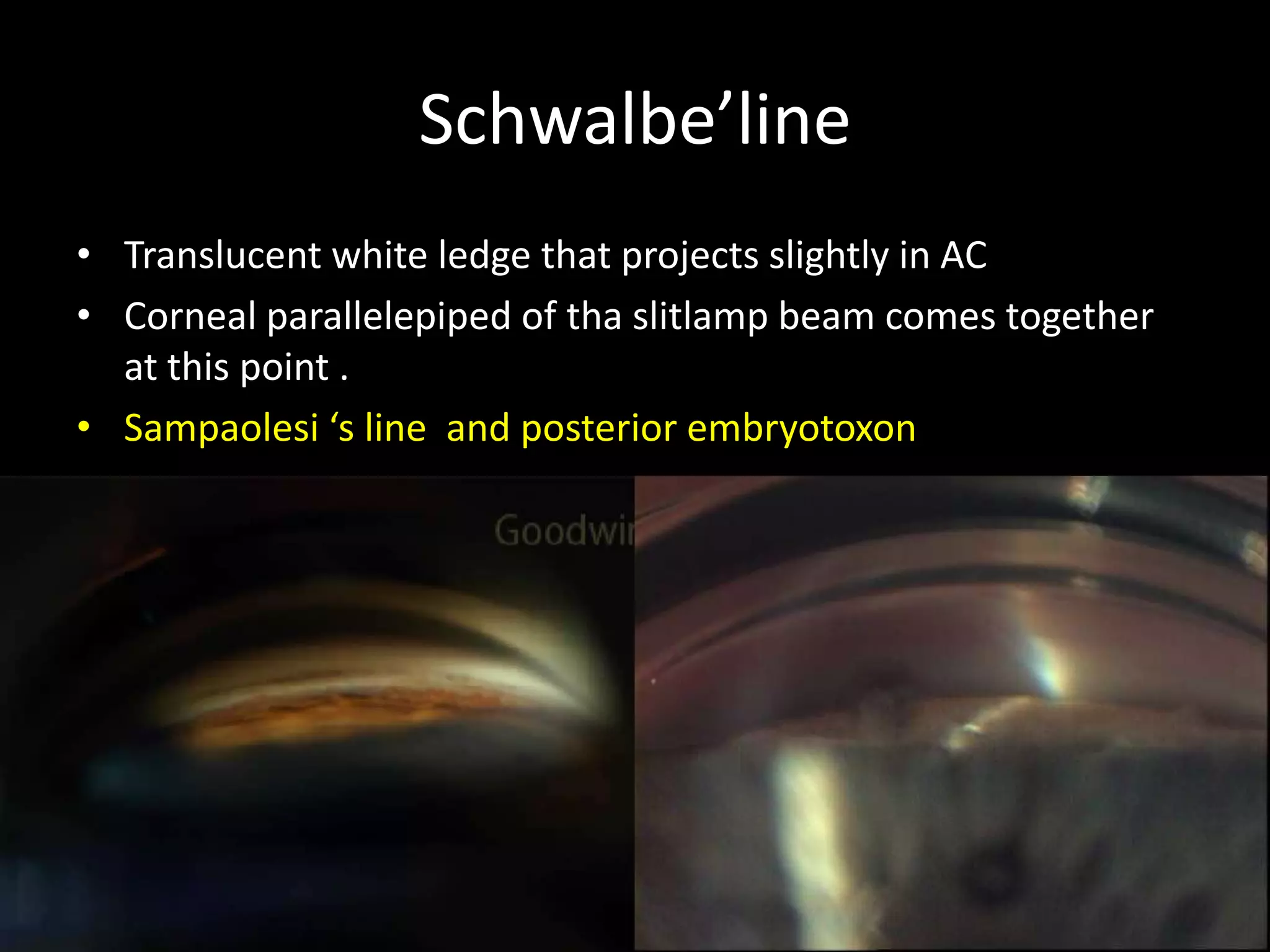 Schwalbe’line
• Translucent white ledge that projects slightly in AC
• Corneal parallelepiped of tha slitlamp beam comes together
  at this point .
• Sampaolesi ‘s line and posterior embryotoxon
 