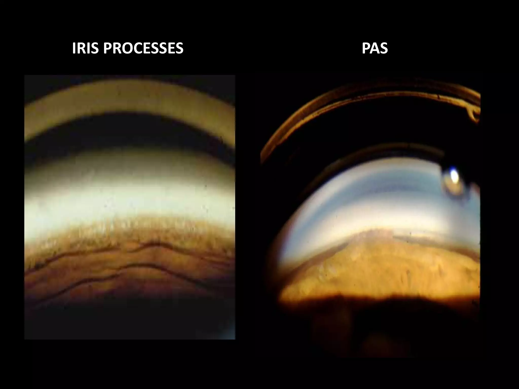 IRIS PROCESSES                          PAS

• Thread like fibers of uveal   • Adherence of iris to angle
  tissue                          structures
• Thin Network of strands,      • Solid and broad
  porus
• Structures behind seen        • Structures behind unseen
• Height : usually SS           • Height : varies
• Peripheral iris tissue wrap   • Peripheral iris tissue butts
  around angle recess             flat against TM
• Blood vessel -ve              • Blood vessel +/_
• Pigmentation - /+ ve          • Pigmentation +
 