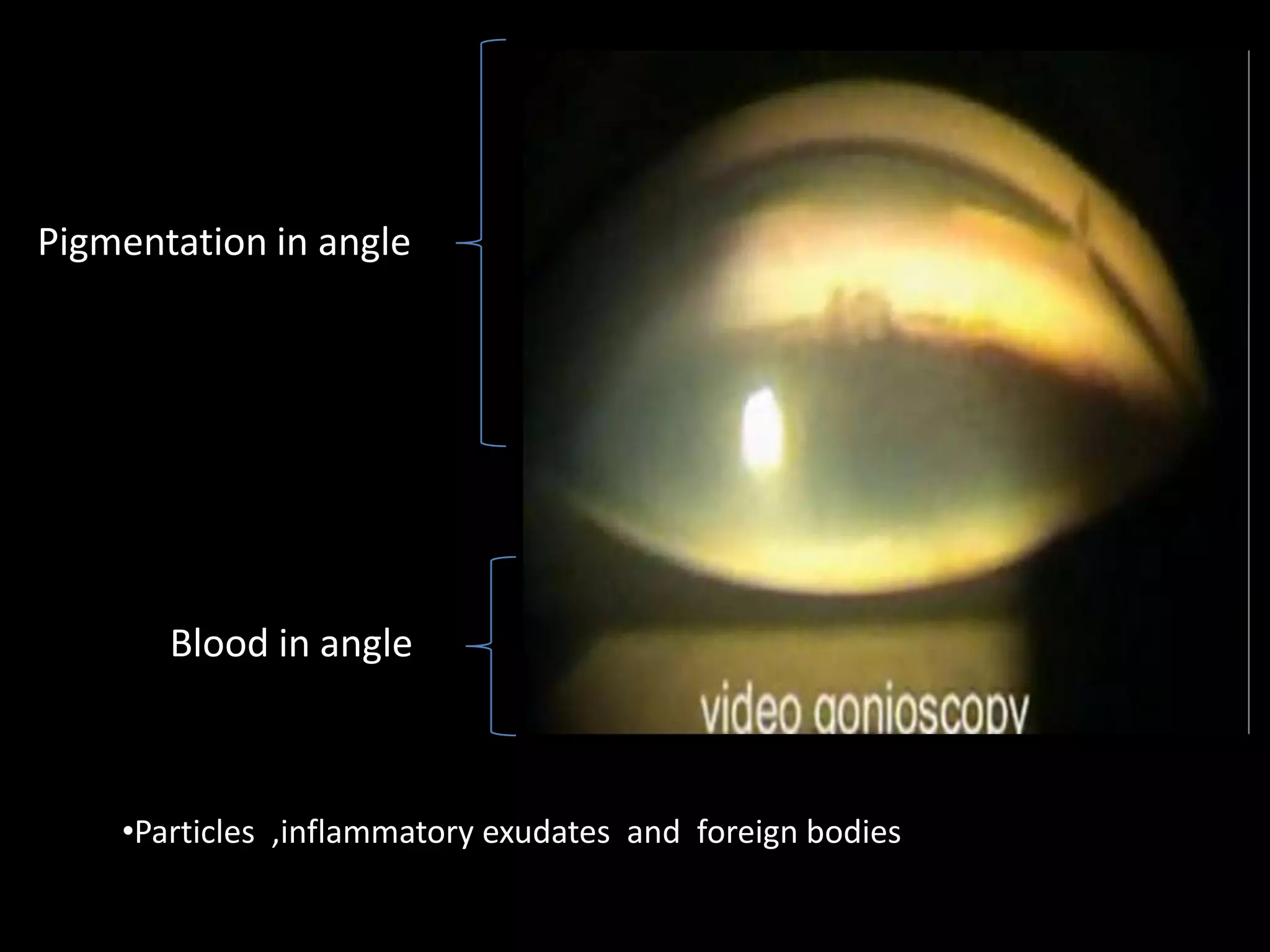 •Should be differentiated from uveal meshwork
                                 •More on inferiorly and nasally.
                                 •Dens band whole circumference:EXF
                                                                    PDS,
Pigmentation in angle                                               pig.glaucoma
                                 •Scattered ,lower parts:previous
                                                          SX,inflammation,
                                                          hyphema
                                 •Black fine ,coarse balls:old blood




                                 Fresh blood :bright red ,
       Blood in angle            old blood : black particals and balls
                                 Organised clot :synechial filling of angle



    •Particles ,inflammatory exudates and foreign bodies
 