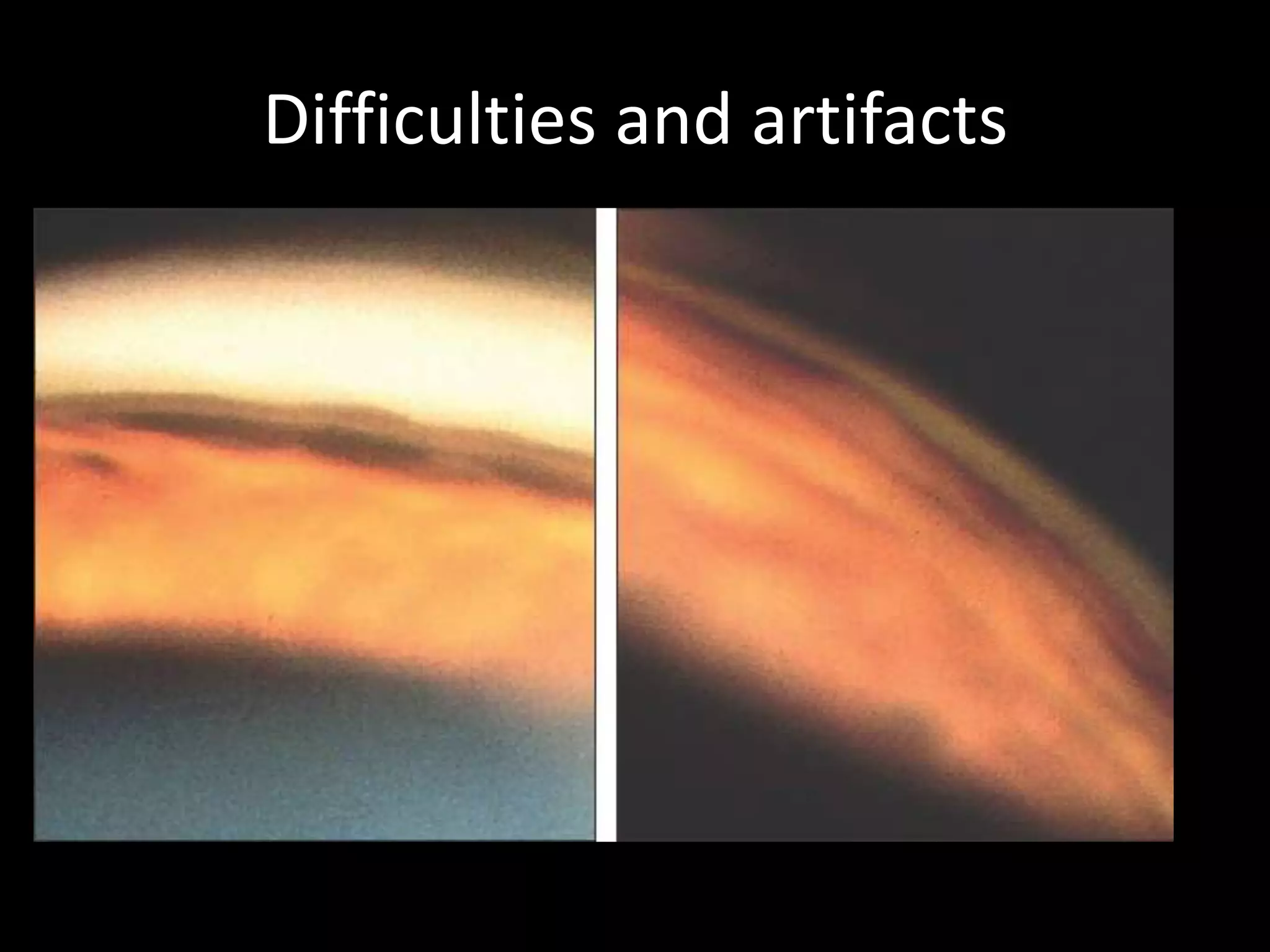 Difficulties and artifacts
• Koeppe lens --- narrow the angle
• Zeiss lens ----- widen the angle by indentation
• Ideal pressure of gonioscopy.
• Dimlight provacaton test:
• Coreal edema : lower IOP ,
                  oral/topicalhyperosmotics
                   epithelial debridment
• Cornea guttata : pebbled ,shagreen appearance
                    against white sclera,,
                    easier with gonio than slitlamp
 