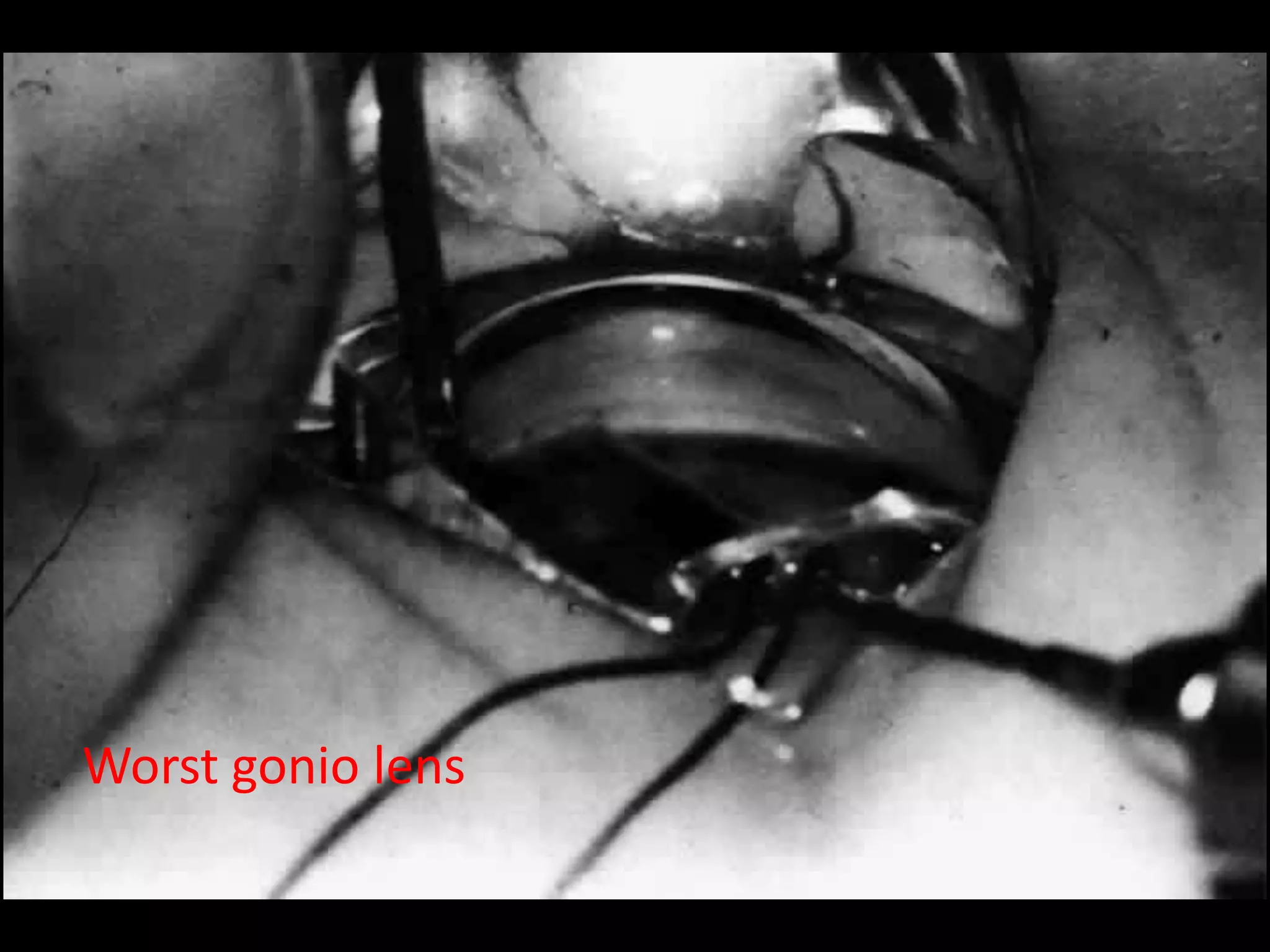 Direct gonioscopy
   Koeppe lens                 Barkan lens
   • Prototype diagnostic      • Prototype surgical lens
     lens


   Richard son - shaffer       Thorpe lens
   • Small koeppe lens         • Surgical and diagnostic lens
   • For use in children       • For operating room


   Layden                      Swan – jacob lens
   • For premature infants .   • Surgical goniolens for use in
Worst gonio lens                 children.
 