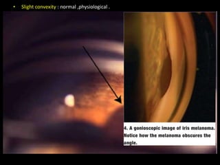 Gonioscopy.new