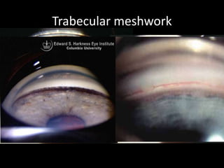Trabevular Meshwork Gonioscopy.new